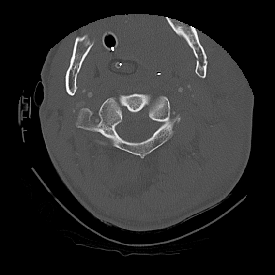 File:Bilateral perched facets with cord injury (Radiopaedia 45587-49713 Axial bone window 30).jpg