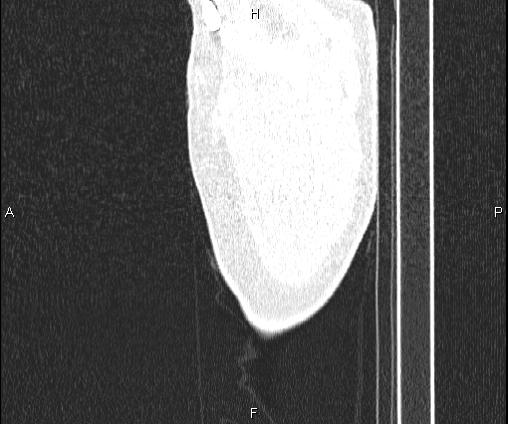 Bilateral pulmonary AVM (Radiopaedia 83134-97505 Sagittal lung window 8).jpg