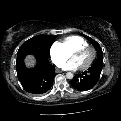 Bilateral pulmonary emboli (Radiopaedia 32700-33669 Axial C+ CTPA 74).jpg