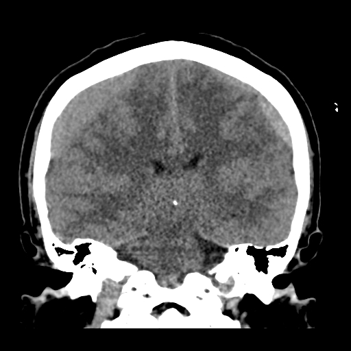 Bilateral subacute subdural hematoma (Radiopaedia 69240-79018 Coronal non-contrast 34).jpg