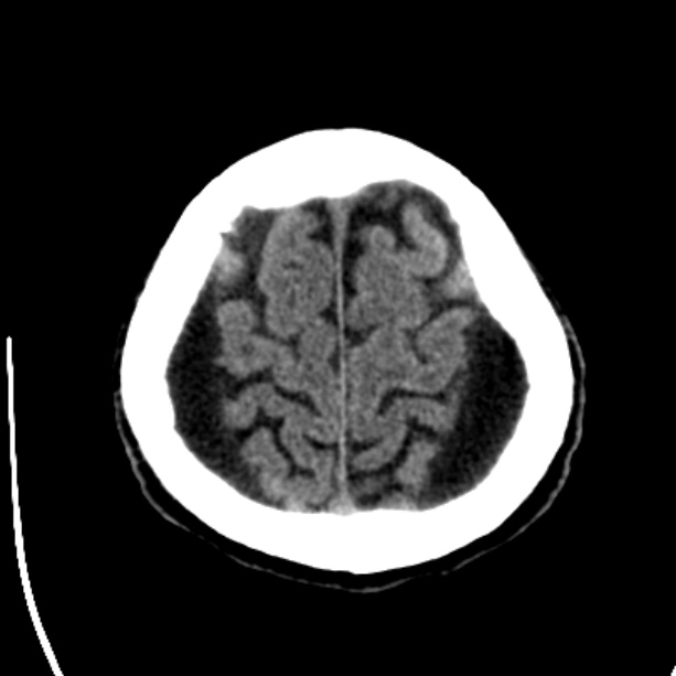 Bilateral subdural hygromata (Radiopaedia 29245-29656 Axial non-contrast 42).jpg
