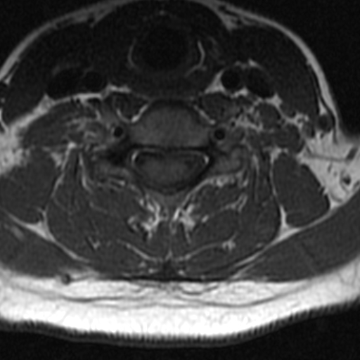 File:Bilateral tortuous vertebral arteries (Radiopaedia 19070-19039 Axial T2 3).jpg