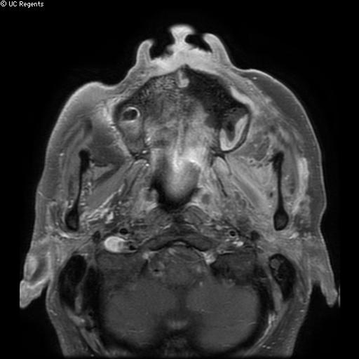 Bisphosphonate-related osteonecrosis of the maxilla (Radiopaedia 51367-57101 Axial T1 C+ fat sat 22).jpg