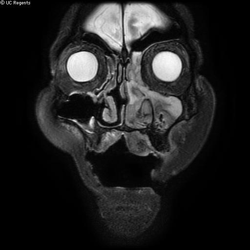 File:Bisphosphonate-related osteonecrosis of the maxilla (Radiopaedia 51367-57101 Coronal T2 fat sat 25).jpg