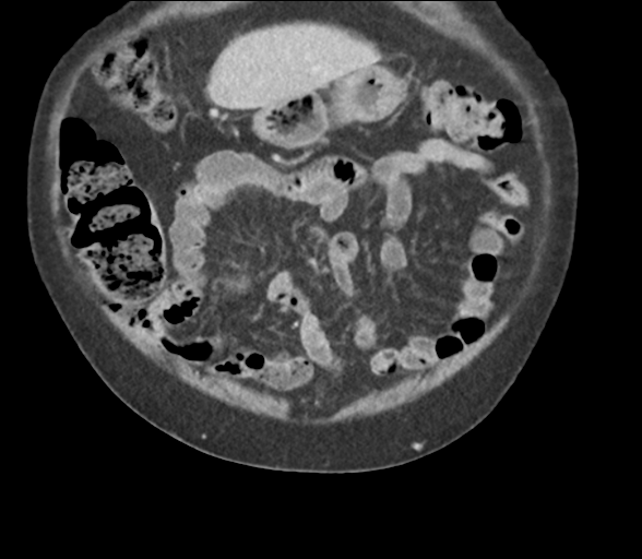 Bladder papillary urothelial carcinoma (Radiopaedia 48119-52951 C 16).png
