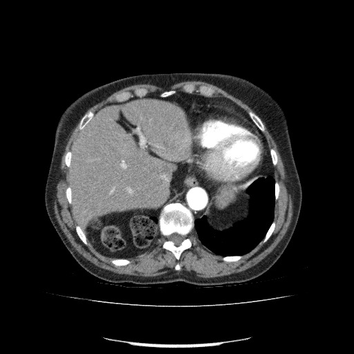 Bladder tumor detected on trauma CT (Radiopaedia 51809-57609 A 76).jpg