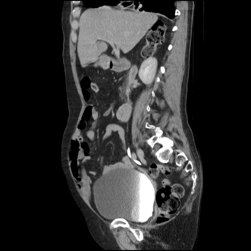Bladder tumor detected on trauma CT (Radiopaedia 51809-57609 E 45).jpg