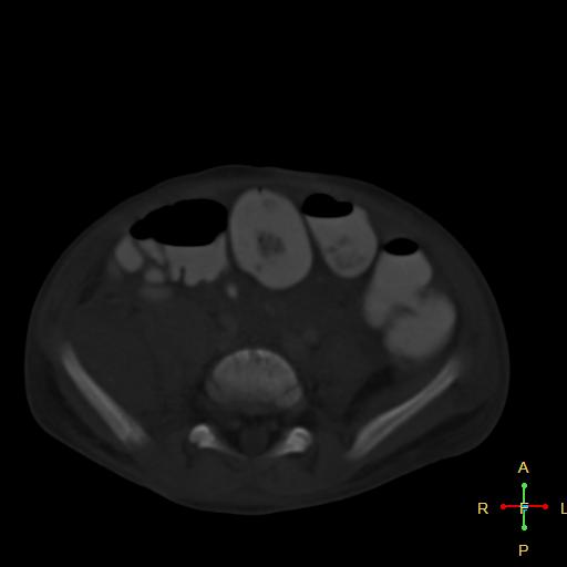 File:Blunt abdominal trauma (Radiopaedia 24780-25044 Axial bone window 5).jpg