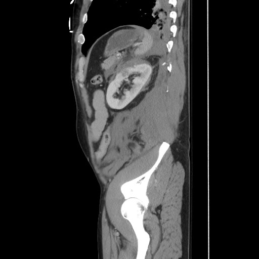 File:Blunt abdominal trauma with solid organ and musculoskelatal injury with active extravasation (Radiopaedia 68364-77895 C 111).jpg