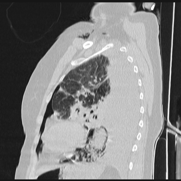 Boerhaave syndrome (Radiopaedia 45644-49799 Sagittal lung window 60).jpg