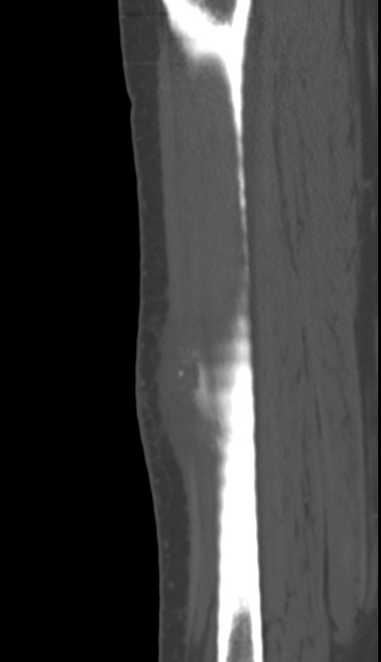 Bone metastasis - tibia (Radiopaedia 57665-64609 Sagittal bone window 113).jpg