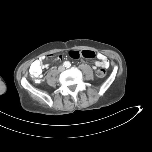 Bone metastasis from squamous cell carcinoma (Radiopaedia 30133-30730 B 46).jpg