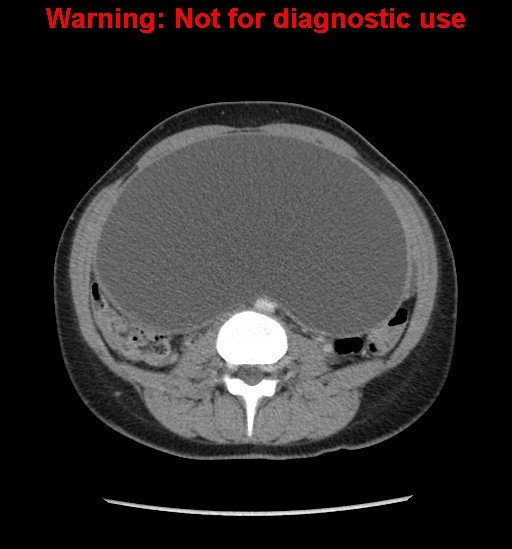 Borderline mucinous cystadenoma of ovary (Radiopaedia 25586-25767 A 35).jpg
