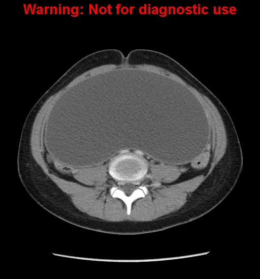 Borderline mucinous cystadenoma of ovary (Radiopaedia 25586-25767 A 51).jpg