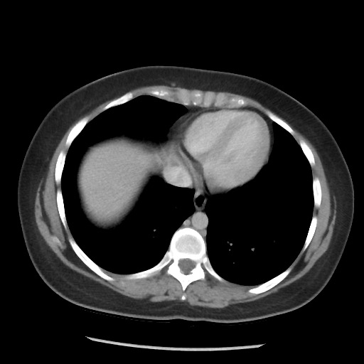 File:Borderline mucinous tumor (ovary) (Radiopaedia 78228-90808 A 62).jpg