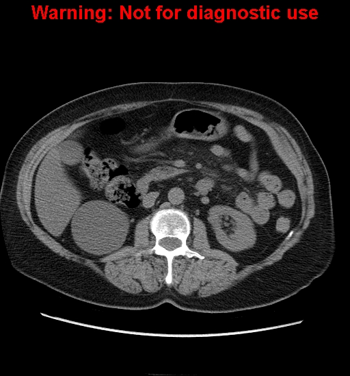 File:Bosniak renal cyst - type II (Radiopaedia 23404-23468 Axial non-contrast 16).jpg