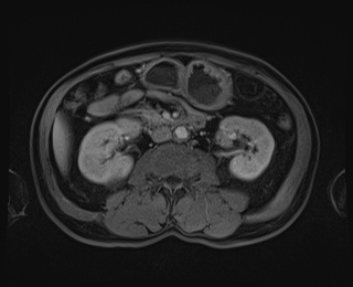 Bouveret syndrome (Radiopaedia 61017-68856 Axial T1 C+ fat sat 48).jpg