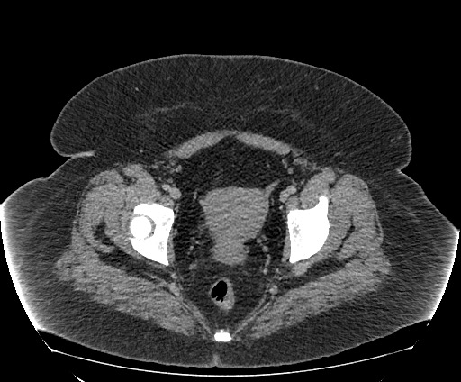 Bowel and splenic infarcts in acute lymphocytic leukemia (Radiopaedia 61055-68913 A 113).jpg