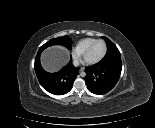 Bowel and splenic infarcts in acute lymphocytic leukemia (Radiopaedia 61055-68913 A 13).jpg