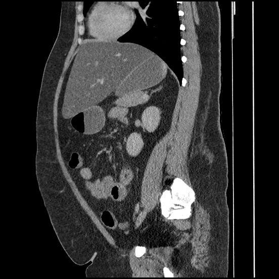 Bowel and splenic infarcts in acute lymphocytic leukemia (Radiopaedia 61055-68913 C 34).jpg