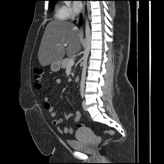 File:Bowel and splenic infarcts in acute lymphocytic leukemia (Radiopaedia 61055-68913 C 41).jpg