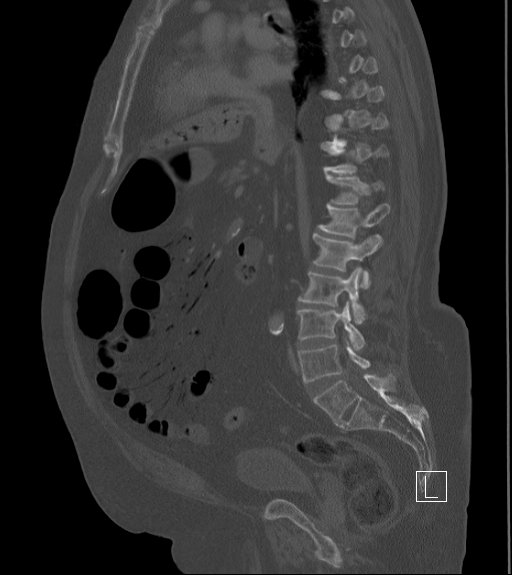 Bowel ischemia secondary to SMA occlusion with extensive portomesenteric venous gas (Radiopaedia 54656-60871 Sagittal bone window 56).jpg