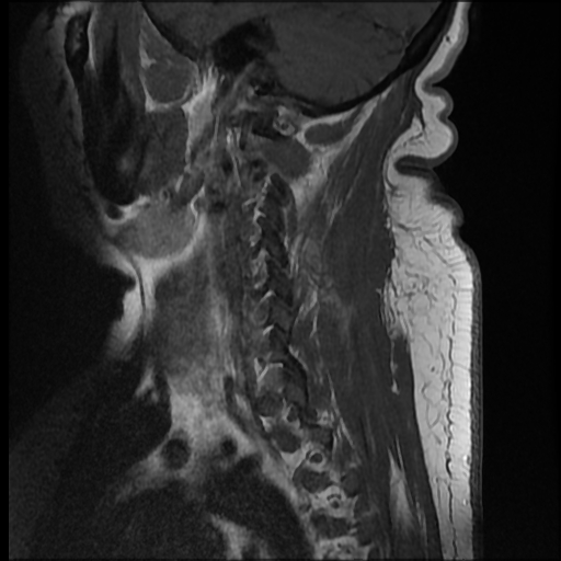 File:Brachial plexopathy (Radiopaedia 21844-21806 Sagittal T1 C+ 1).jpg