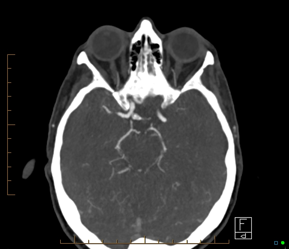 Brachiocephalic trunk stenosis (Radiopaedia 87242-103519 A 43).jpg
