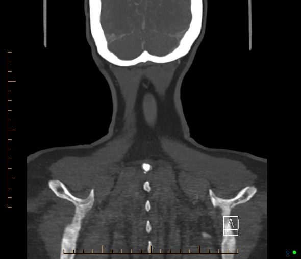 Brachiocephalic trunk stenosis (Radiopaedia 87242-103519 B 69).jpg