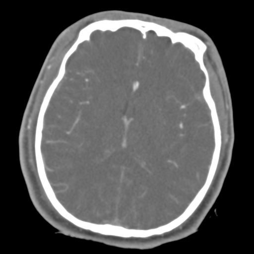 Brain contusions, internal carotid artery dissection and base of skull fracture (Radiopaedia 34089-35339 D 25).png