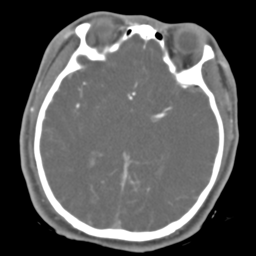 Brain contusions, internal carotid artery dissection and base of skull fracture (Radiopaedia 34089-35339 D 29).png