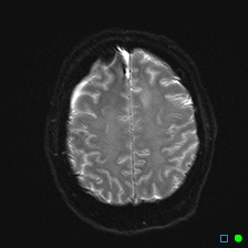File:Brain death on MRI and CT angiography (Radiopaedia 42560-45689 Axial ADC 25).jpg