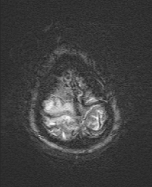 Brain metastases - lung cancer primary (Radiopaedia 75060-86115 Axial SWI 56).jpg