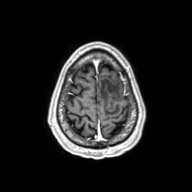Brain metastases from lung cancer (Radiopaedia 83839-99028 Axial T1 C+ 61).jpg
