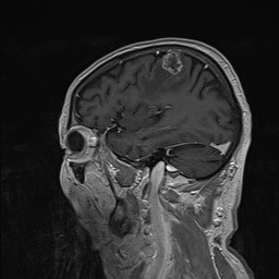 Brain metastasis (Radiopaedia 42617-45761 Sagittal T1 C+ 26).jpg