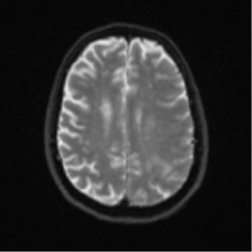 Brain metastasis (large cystic mass) (Radiopaedia 47497-52107 Axial DWI 19).png
