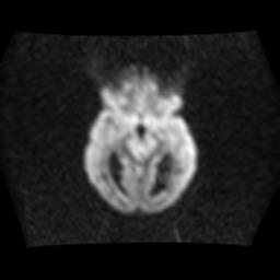 File:Brainstem glioma (Radiopaedia 30923-31624 Axial DWI 9).jpg