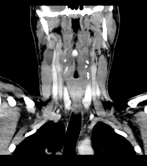 Branchial cleft cyst (Radiopaedia 31167-31875 Coronal C+ delayed 34).jpg