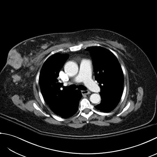 Breast carcinoma with pathological hip fracture (Radiopaedia 60314-67974 A 23).jpg