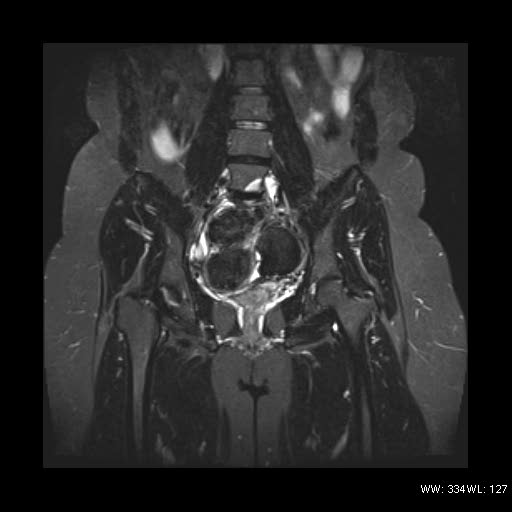 File:Broad ligament fibroid (Radiopaedia 49135-54241 Coronal STIR 15).jpg