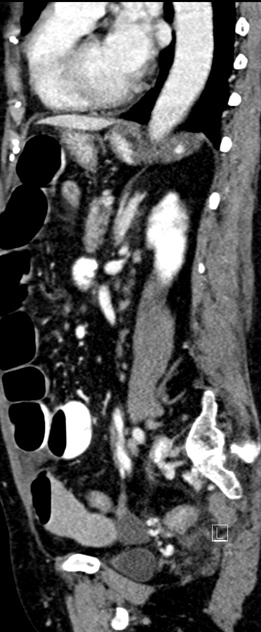 Broad ligament hernia (Radiopaedia 84802-100276 C 27).jpg