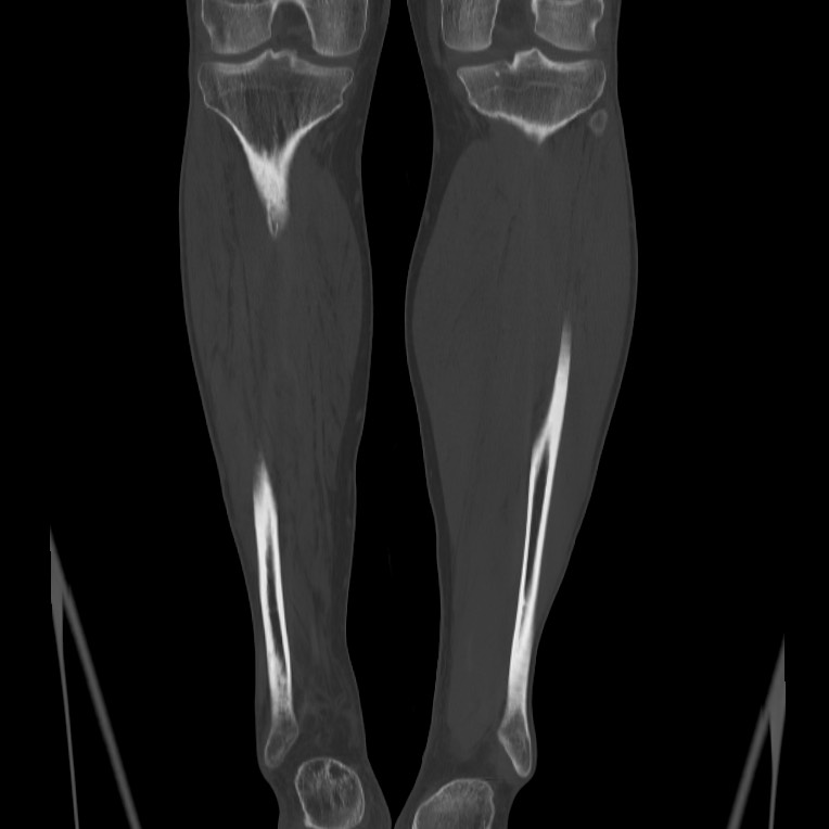 Brodie abscess - tibia (Radiopaedia 66028-75204 Coronal bone window 51).jpg