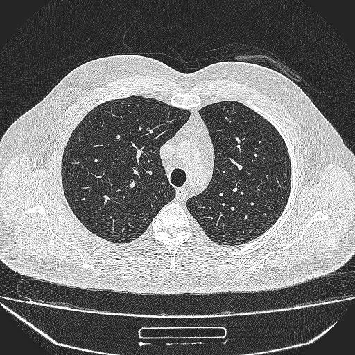 File:Bronchial atresia (Radiopaedia 58271-65417 Axial lung window 12).jpg