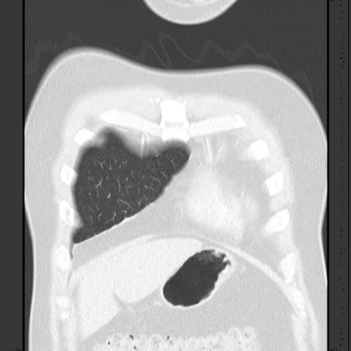 Bronchial carcinoid tumor (Radiopaedia 67377-76764 Coronal lung window 19).jpg