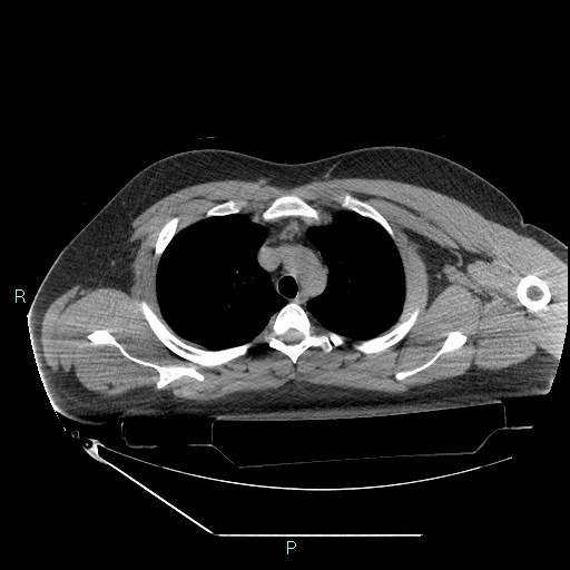 Bronchial carcinoid tumor (Radiopaedia 78272-90870 Axial non-contrast 26).jpg