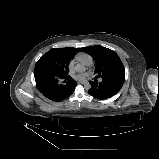 Bronchial carcinoid tumor (Radiopaedia 78272-90870 Axial non-contrast 53).jpg