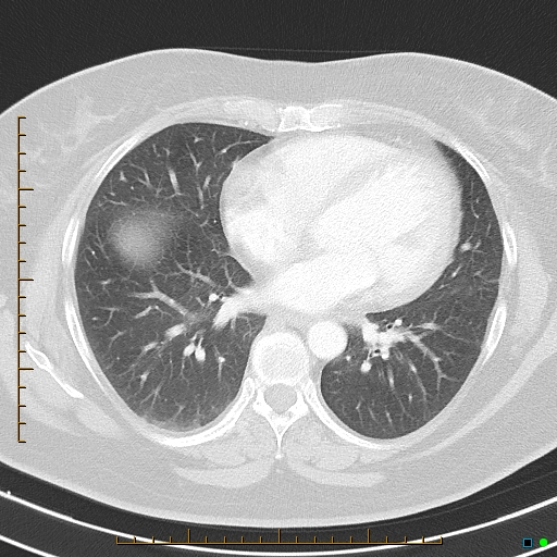 Bronchial diverticula (Radiopaedia 79512-92675 Axial lung window 30).jpg