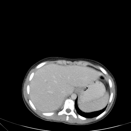 Bronchial mucoepidermoid carcinoma (Radiopaedia 57023-63895 Axial 91).jpg