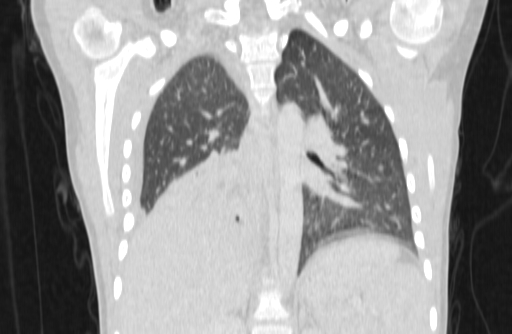 Bronchial mucoepidermoid carcinoma (Radiopaedia 57023-63895 Coronal lung window 41).jpg