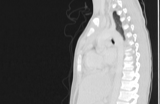 Bronchial mucoepidermoid carcinoma (Radiopaedia 57023-63895 Sagittal lung window 97).jpg